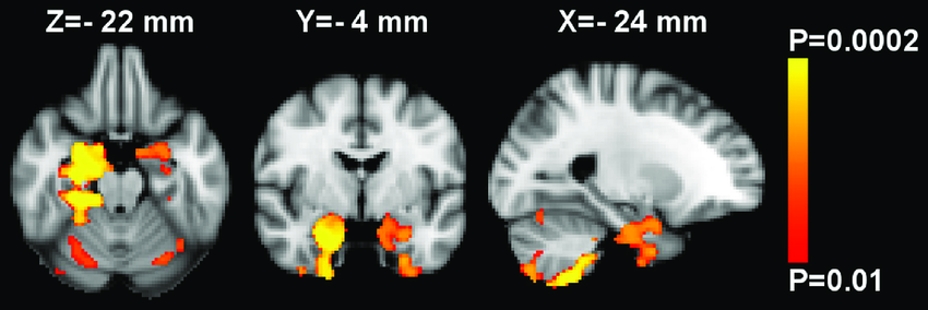 ENIGMA STROKE VBM